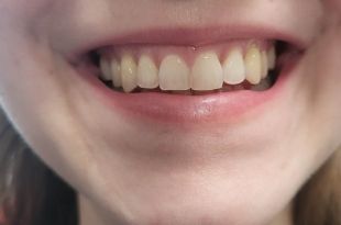 Láthatatlan fogszabályozó kezelés 4 hónap