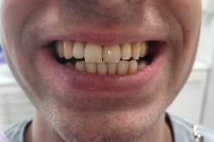 Láthatatlan fogszabályozó kezelés 5 hónap