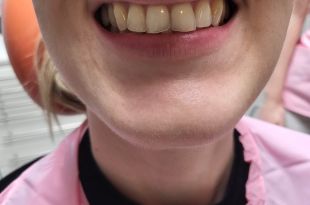 Láthatatlan fogszabályozó kezelés 5 hónap