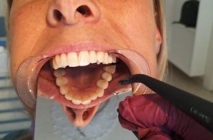 Láthatatlan fogszabályozó kezelés 7 hónap
